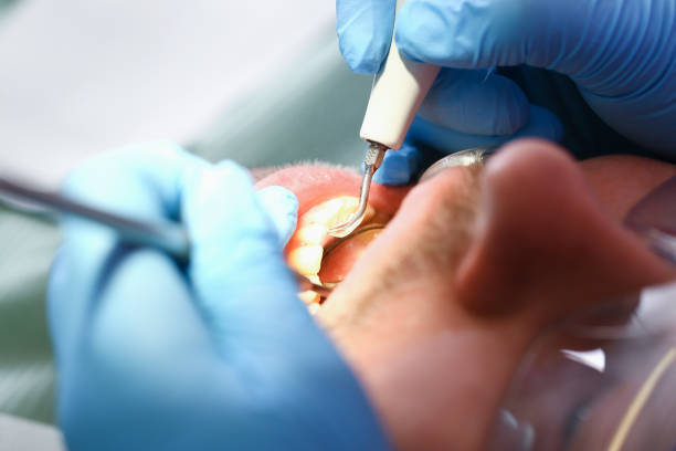 Best Emergency Dentist for Knocked-Out Tooth in Sweetwater, TX